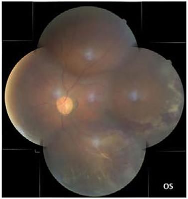 Cytomegalovirus-Immune Recovery Retinitis After Initiation of Highly Active Antiretroviral Therapy: A Case Series